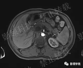 影像PPT - 【病例】胰腺导管内乳头状黏液肿瘤1例MR影像-39 影像PPT - 【病例】胰腺导管内乳头状黏液肿瘤1例MR影像-39