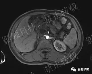 影像PPT - 【病例】胰腺导管内乳头状黏液肿瘤1例MR影像-40 影像PPT - 【病例】胰腺导管内乳头状黏液肿瘤1例MR影像-40