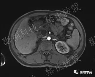 影像PPT - 【病例】胰腺导管内乳头状黏液肿瘤1例MR影像-41 影像PPT - 【病例】胰腺导管内乳头状黏液肿瘤1例MR影像-41