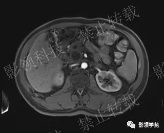 影像PPT - 【病例】胰腺导管内乳头状黏液肿瘤1例MR影像-42 影像PPT - 【病例】胰腺导管内乳头状黏液肿瘤1例MR影像-42