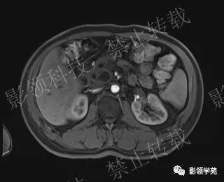 影像PPT - 【病例】胰腺导管内乳头状黏液肿瘤1例MR影像-43 影像PPT - 【病例】胰腺导管内乳头状黏液肿瘤1例MR影像-43