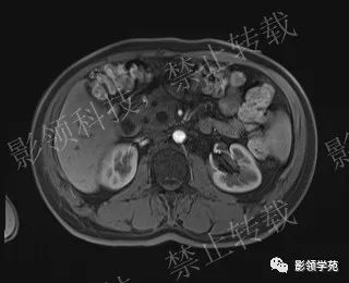 影像PPT - 【病例】胰腺导管内乳头状黏液肿瘤1例MR影像-44 影像PPT - 【病例】胰腺导管内乳头状黏液肿瘤1例MR影像-44