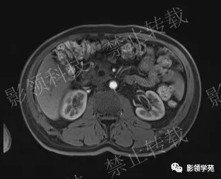 影像PPT - 【病例】胰腺导管内乳头状黏液肿瘤1例MR影像-45 影像PPT - 【病例】胰腺导管内乳头状黏液肿瘤1例MR影像-45