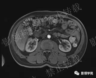 影像PPT - 【病例】胰腺导管内乳头状黏液肿瘤1例MR影像-46 影像PPT - 【病例】胰腺导管内乳头状黏液肿瘤1例MR影像-46