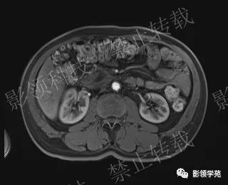 影像PPT - 【病例】胰腺导管内乳头状黏液肿瘤1例MR影像-47 影像PPT - 【病例】胰腺导管内乳头状黏液肿瘤1例MR影像-47