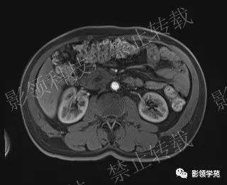 影像PPT - 【病例】胰腺导管内乳头状黏液肿瘤1例MR影像-48 影像PPT - 【病例】胰腺导管内乳头状黏液肿瘤1例MR影像-48