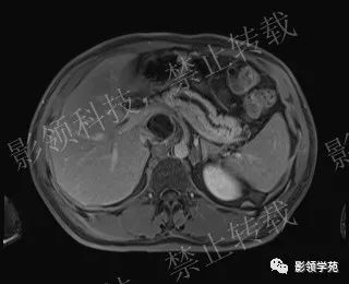 影像PPT - 【病例】胰腺导管内乳头状黏液肿瘤1例MR影像-49 影像PPT - 【病例】胰腺导管内乳头状黏液肿瘤1例MR影像-49