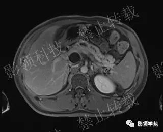 影像PPT - 【病例】胰腺导管内乳头状黏液肿瘤1例MR影像-50 影像PPT - 【病例】胰腺导管内乳头状黏液肿瘤1例MR影像-50