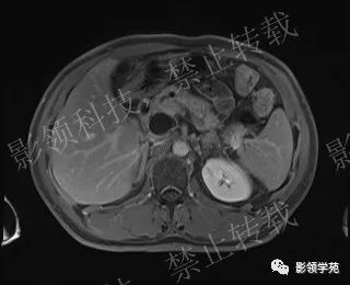 影像PPT - 【病例】胰腺导管内乳头状黏液肿瘤1例MR影像-51 影像PPT - 【病例】胰腺导管内乳头状黏液肿瘤1例MR影像-51