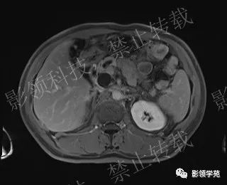影像PPT - 【病例】胰腺导管内乳头状黏液肿瘤1例MR影像-52 影像PPT - 【病例】胰腺导管内乳头状黏液肿瘤1例MR影像-52