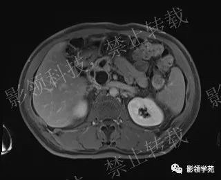 影像PPT - 【病例】胰腺导管内乳头状黏液肿瘤1例MR影像-53 影像PPT - 【病例】胰腺导管内乳头状黏液肿瘤1例MR影像-53