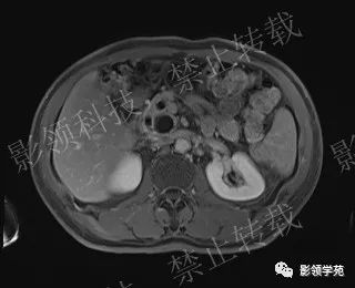 影像PPT - 【病例】胰腺导管内乳头状黏液肿瘤1例MR影像-54 影像PPT - 【病例】胰腺导管内乳头状黏液肿瘤1例MR影像-54