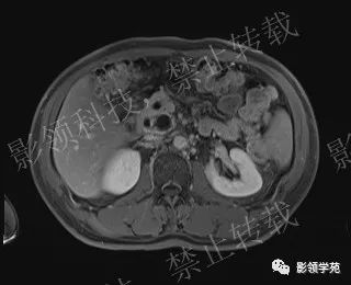 影像PPT - 【病例】胰腺导管内乳头状黏液肿瘤1例MR影像-55 影像PPT - 【病例】胰腺导管内乳头状黏液肿瘤1例MR影像-55