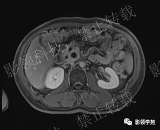 影像PPT - 【病例】胰腺导管内乳头状黏液肿瘤1例MR影像-56 影像PPT - 【病例】胰腺导管内乳头状黏液肿瘤1例MR影像-56