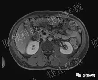 影像PPT - 【病例】胰腺导管内乳头状黏液肿瘤1例MR影像-57 影像PPT - 【病例】胰腺导管内乳头状黏液肿瘤1例MR影像-57