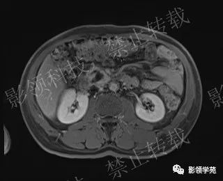 影像PPT - 【病例】胰腺导管内乳头状黏液肿瘤1例MR影像-58 影像PPT - 【病例】胰腺导管内乳头状黏液肿瘤1例MR影像-58