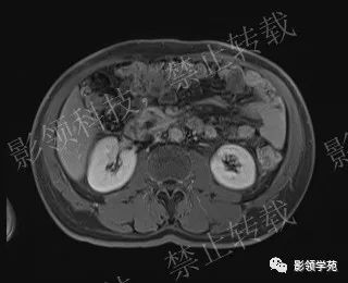 影像PPT - 【病例】胰腺导管内乳头状黏液肿瘤1例MR影像-59 影像PPT - 【病例】胰腺导管内乳头状黏液肿瘤1例MR影像-59