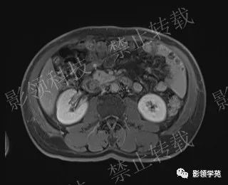 影像PPT - 【病例】胰腺导管内乳头状黏液肿瘤1例MR影像-60 影像PPT - 【病例】胰腺导管内乳头状黏液肿瘤1例MR影像-60