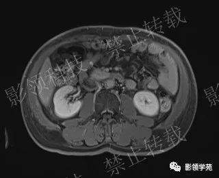 影像PPT - 【病例】胰腺导管内乳头状黏液肿瘤1例MR影像-61 影像PPT - 【病例】胰腺导管内乳头状黏液肿瘤1例MR影像-61