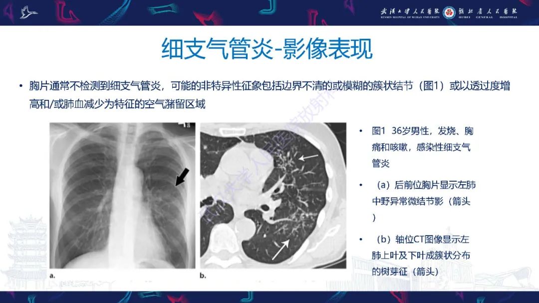 影像PPT - 【PPT】细支气管炎影像诊断-7