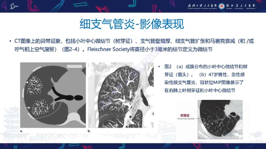影像PPT - 【PPT】细支气管炎影像诊断-8