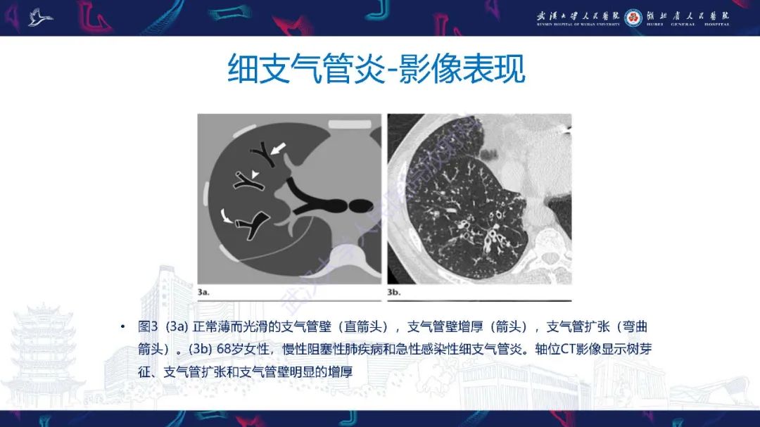 影像PPT - 【PPT】细支气管炎影像诊断-9