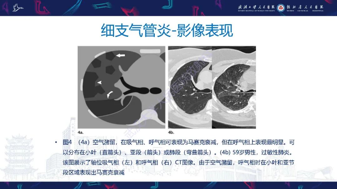 影像PPT - 【PPT】细支气管炎影像诊断-10