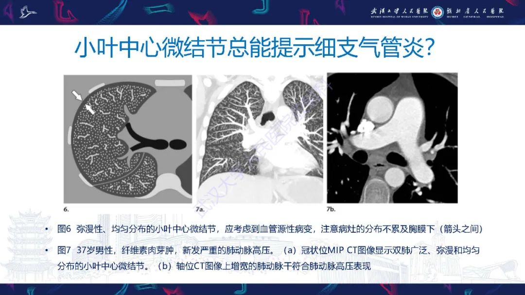 影像PPT - 【PPT】细支气管炎影像诊断-17