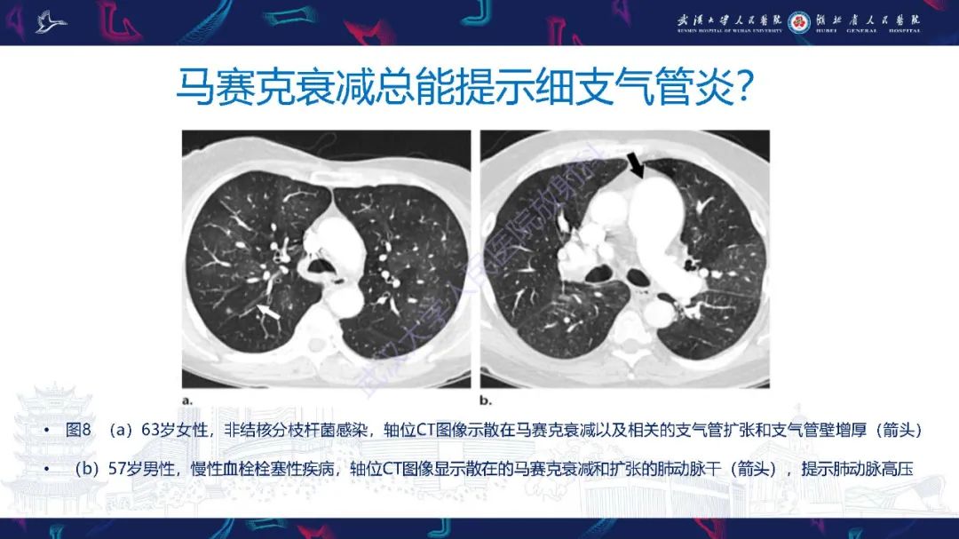 影像PPT - 【PPT】细支气管炎影像诊断-19