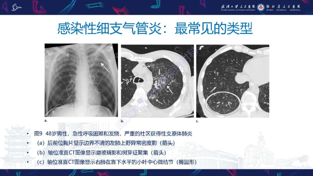 影像PPT - 【PPT】细支气管炎影像诊断-21