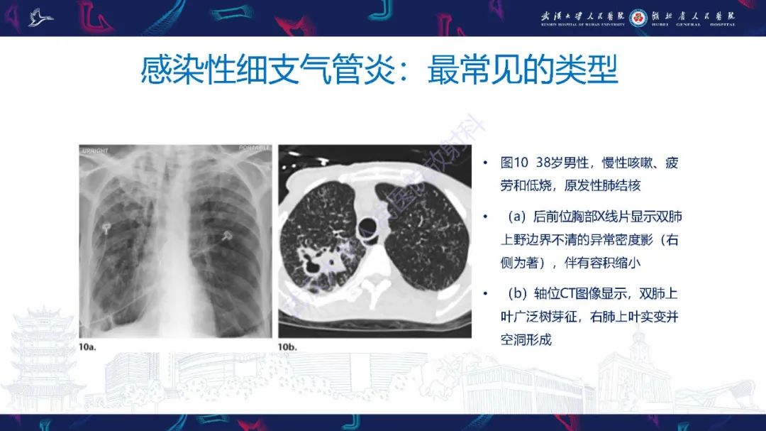 影像PPT - 【PPT】细支气管炎影像诊断-22