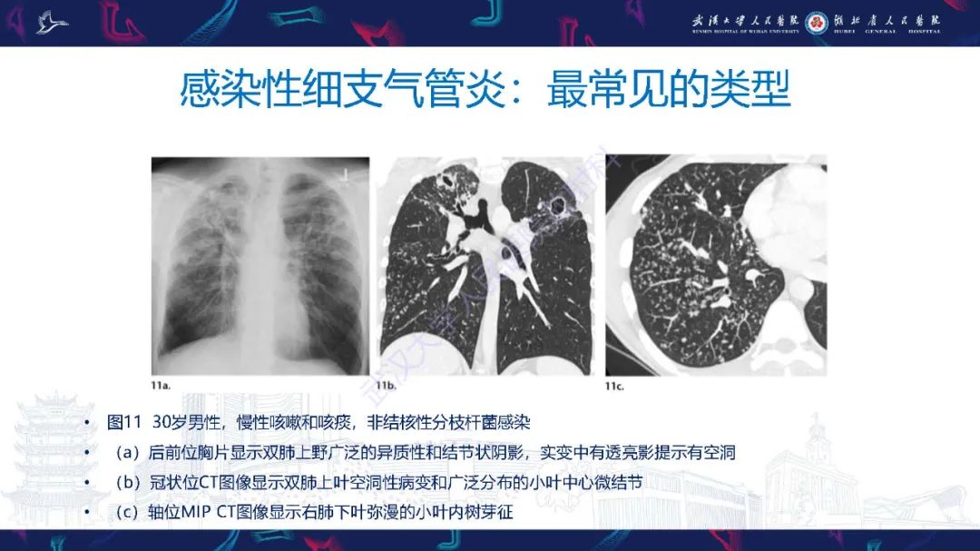 影像PPT - 【PPT】细支气管炎影像诊断-23