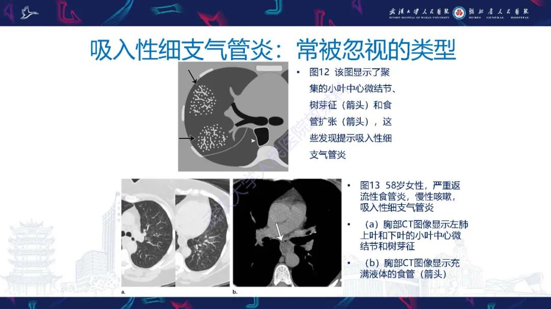 影像PPT - 【PPT】细支气管炎影像诊断-25
