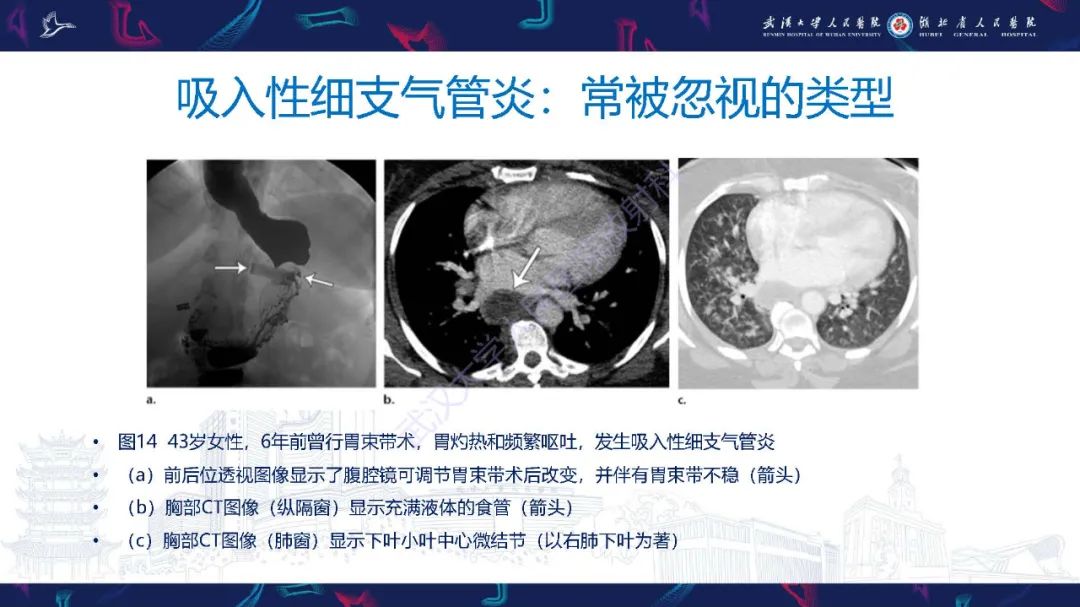 影像PPT - 【PPT】细支气管炎影像诊断-26