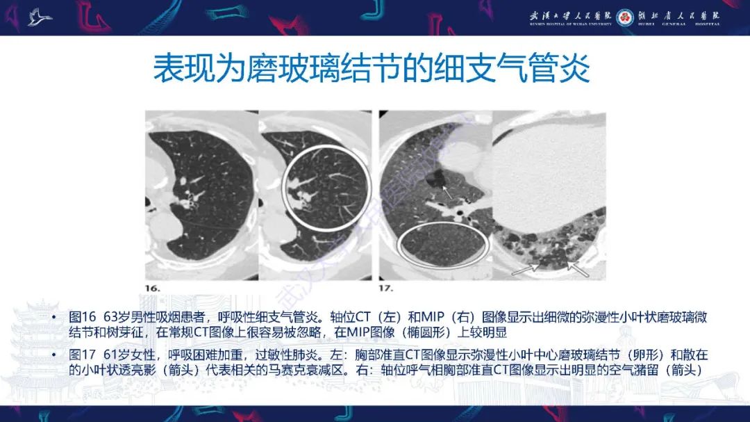 影像PPT - 【PPT】细支气管炎影像诊断-29