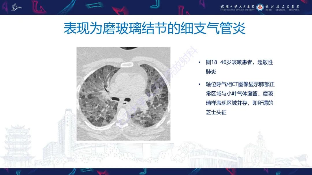 影像PPT - 【PPT】细支气管炎影像诊断-30