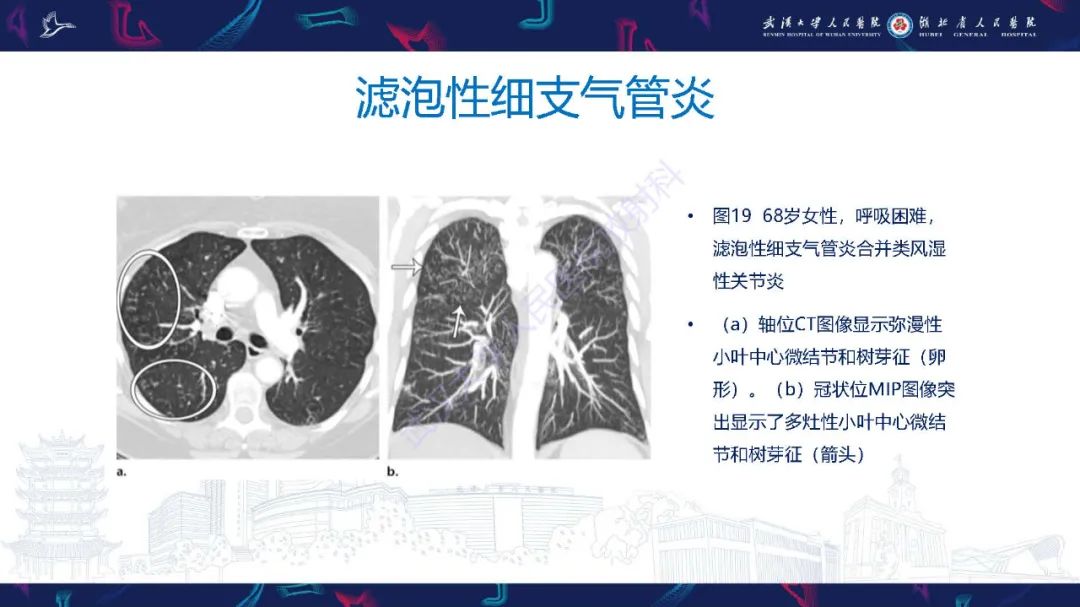 影像PPT - 【PPT】细支气管炎影像诊断-32