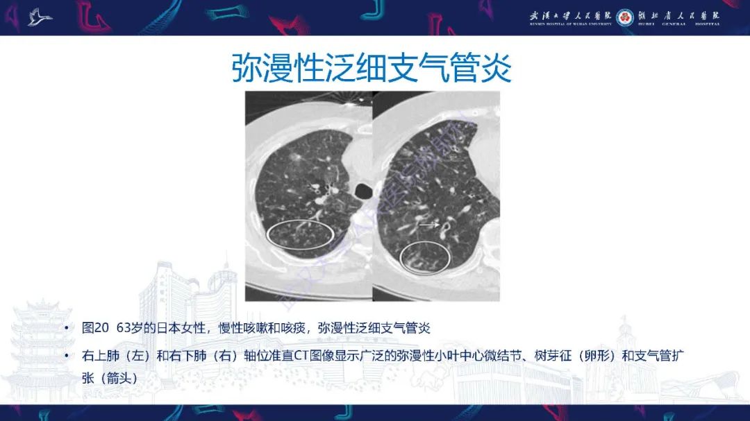影像PPT - 【PPT】细支气管炎影像诊断-34
