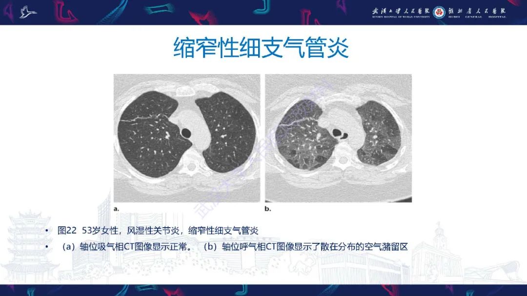 影像PPT - 【PPT】细支气管炎影像诊断-38