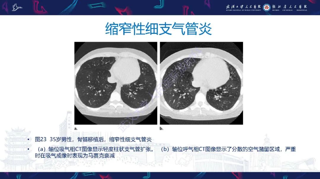 影像PPT - 【PPT】细支气管炎影像诊断-39
