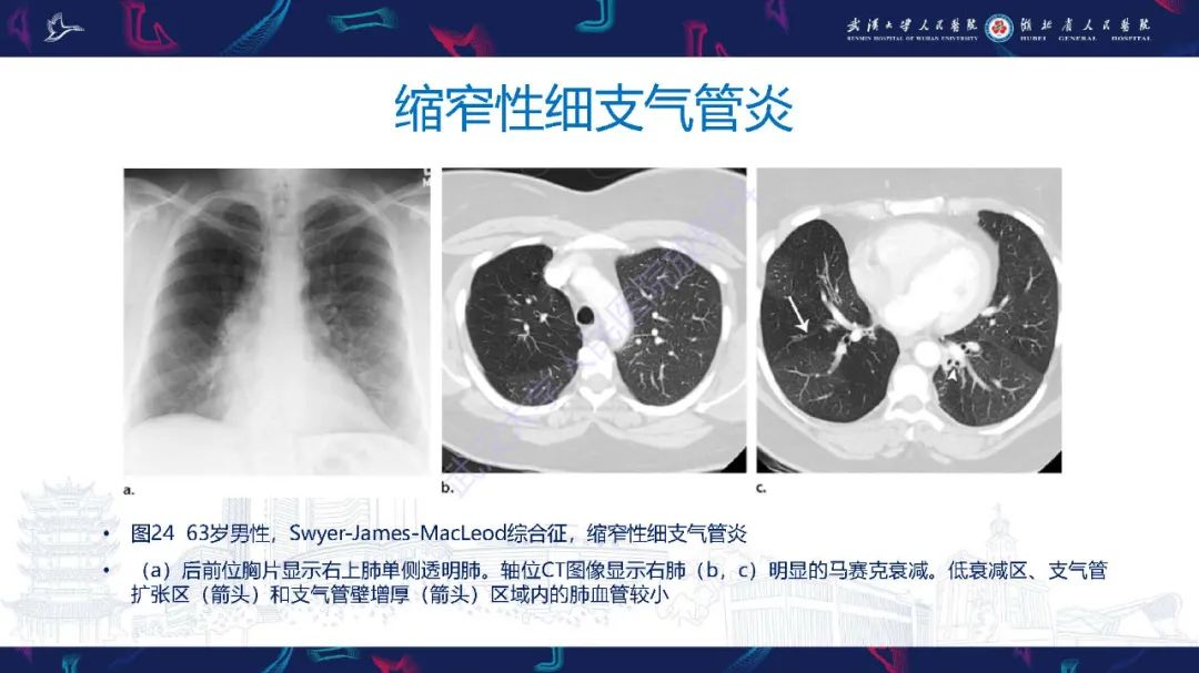 影像PPT - 【PPT】细支气管炎影像诊断-40