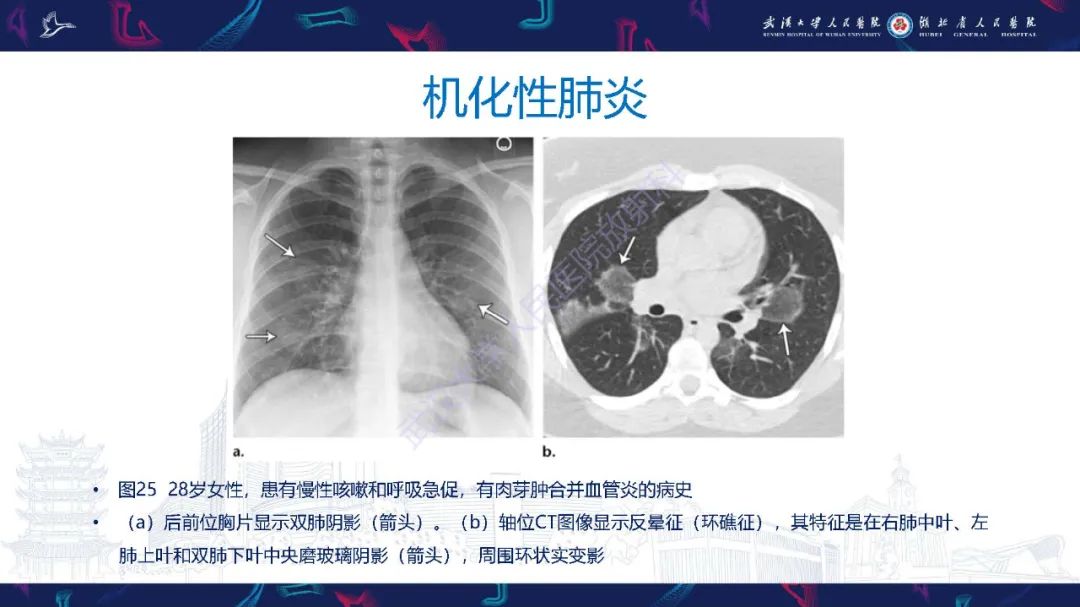 影像PPT - 【PPT】细支气管炎影像诊断-42