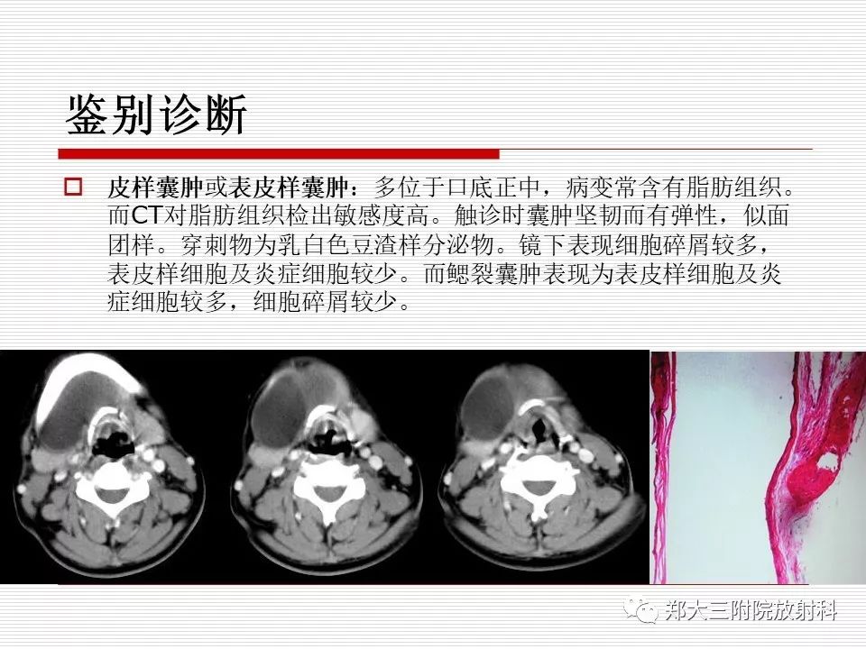 影像PPT - 【PPT】鳃裂囊肿的影像-9