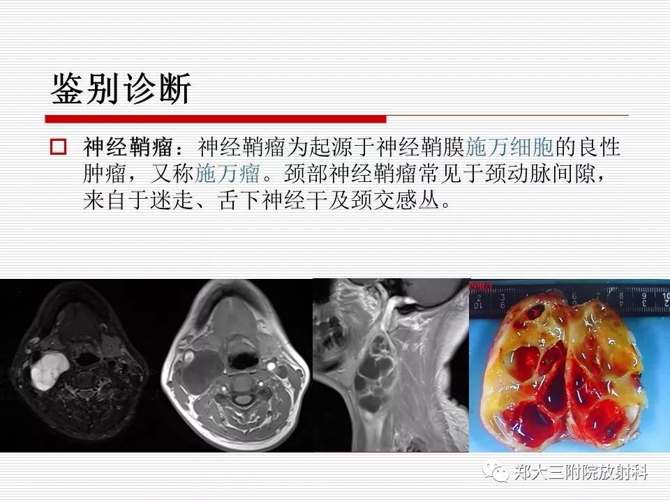 影像PPT - 【PPT】鳃裂囊肿的影像-10