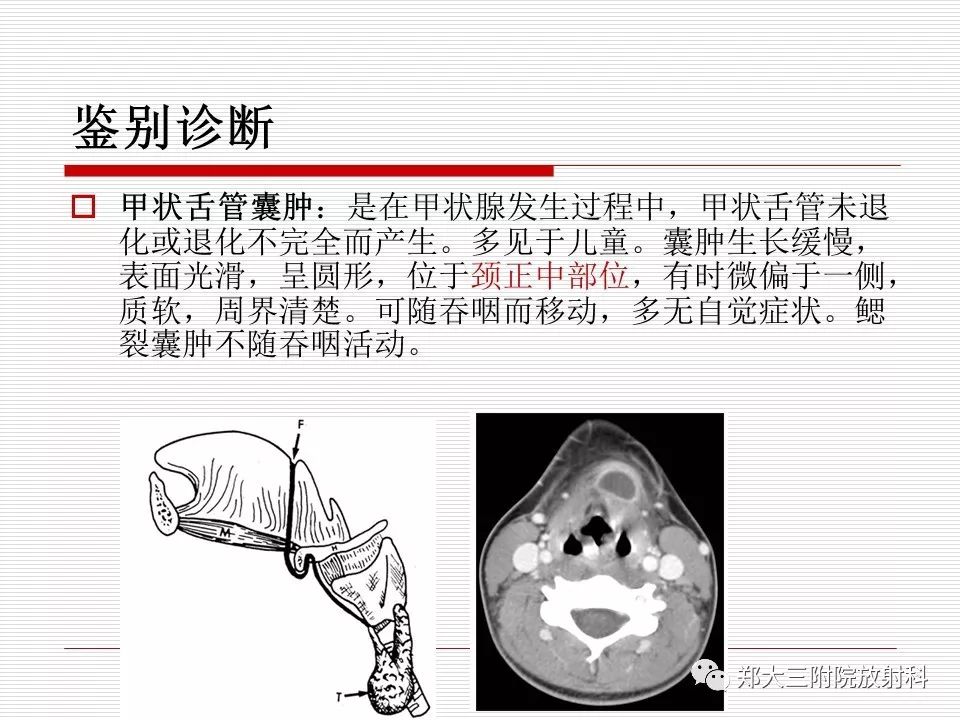 影像PPT - 【PPT】鳃裂囊肿的影像-11