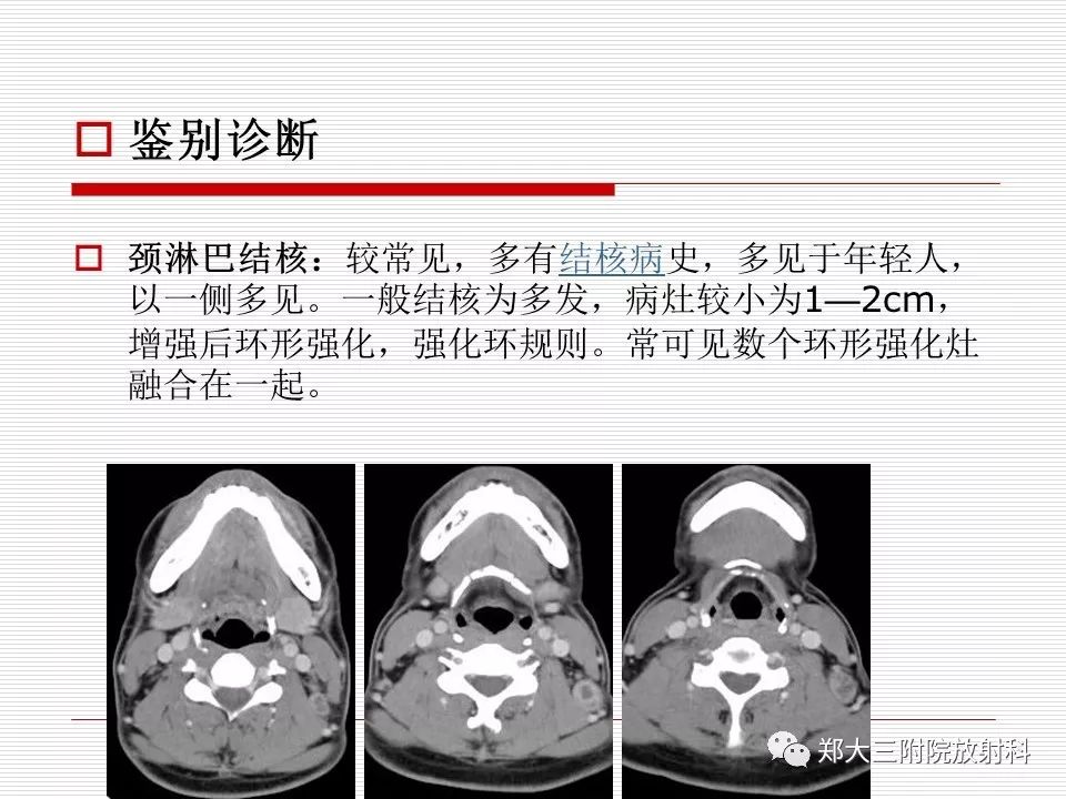 影像PPT - 【PPT】鳃裂囊肿的影像-13