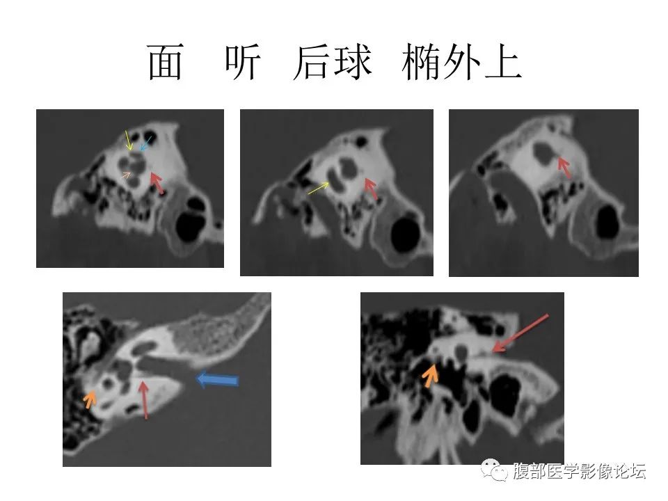 影像PPT - 【PPT】颅骨颅底系列之面面俱到细微处（面神经）-19