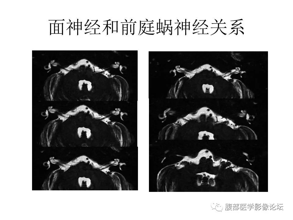 影像PPT - 【PPT】颅骨颅底系列之面面俱到细微处（面神经）-20