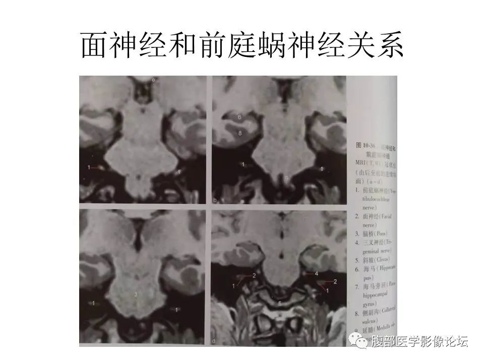 影像PPT - 【PPT】颅骨颅底系列之面面俱到细微处（面神经）-21