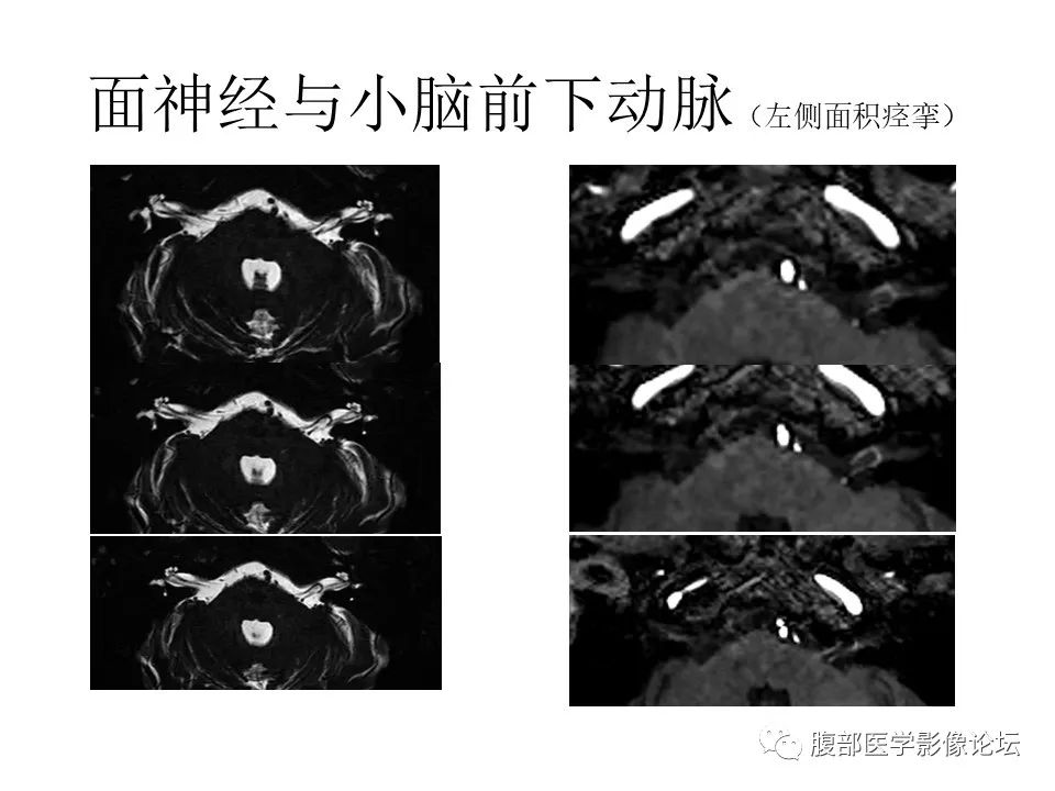 影像PPT - 【PPT】颅骨颅底系列之面面俱到细微处（面神经）-23